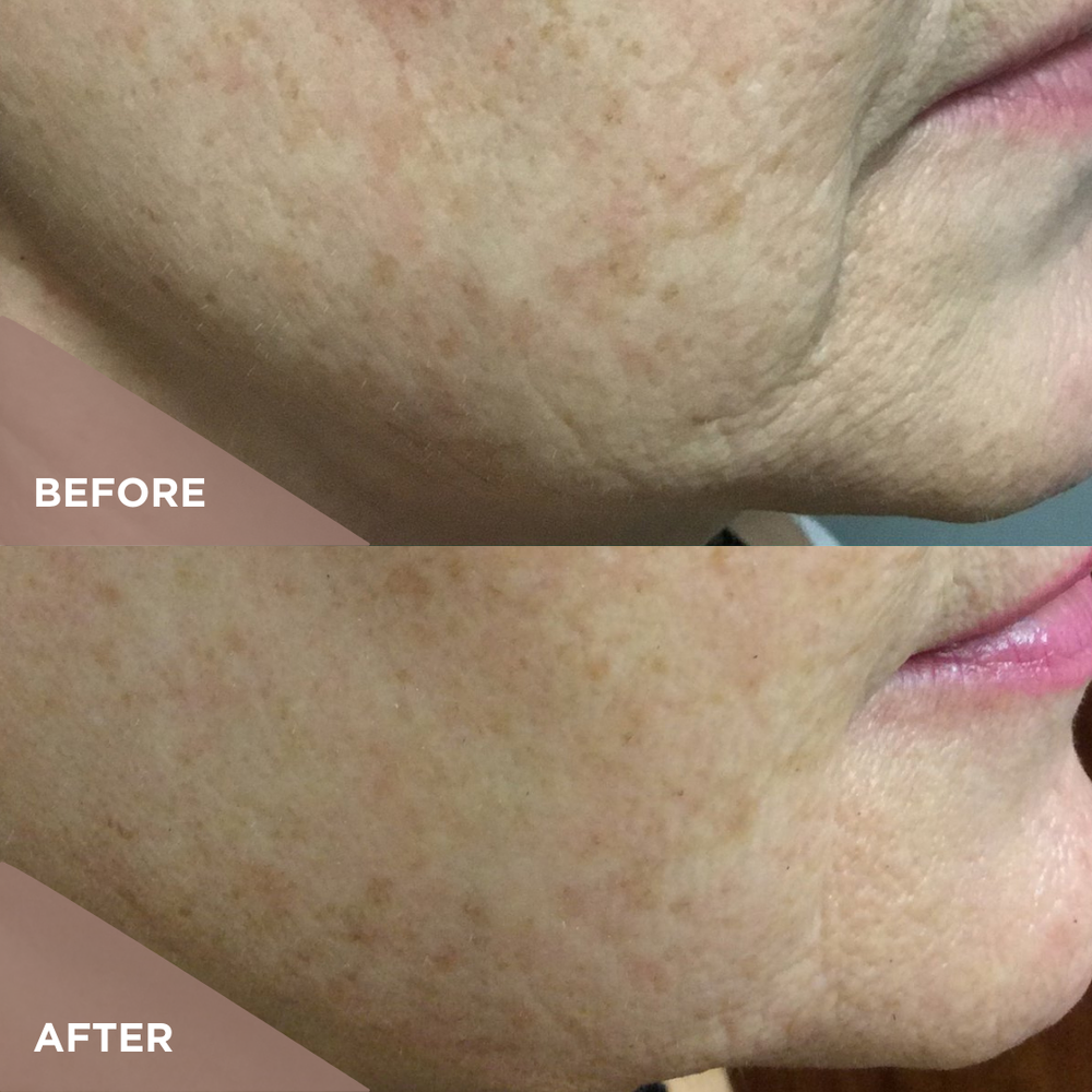 Skin Firming | Microneedling RF — Three Sisters Laser + Medical